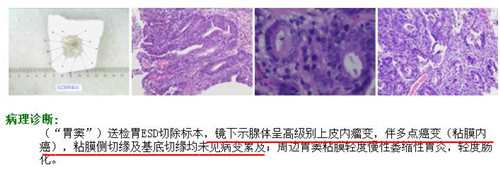 術(shù)后病理_副本.jpg