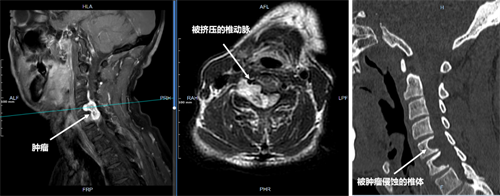 術(shù)前影像可見腫瘤侵蝕多個(gè)椎體，壓迫脊髓及椎動(dòng)脈.png